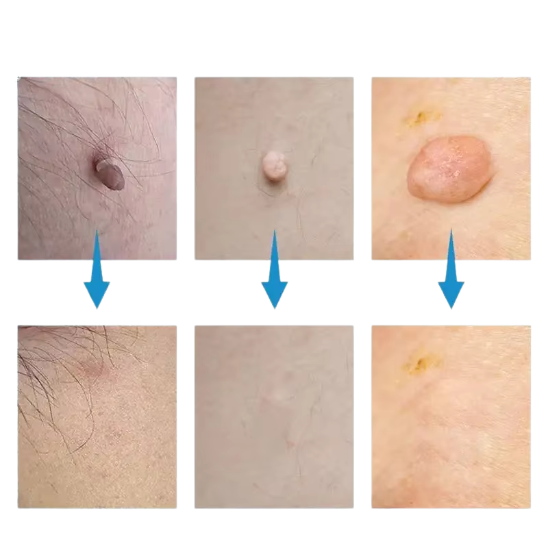 Súprava na odstraňovanie materských znamienok SkinSilence™