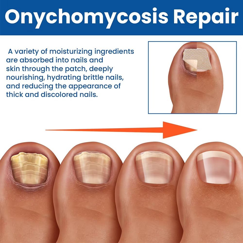 Nočné opravné náplasti NailNurture™ proti plesniam nechtov