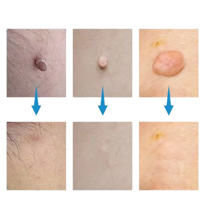 Súprava na odstraňovanie materských znamienok SkinSilence™