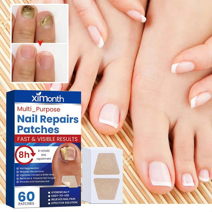 Nočné opravné náplasti NailNurture™ proti plesniam nechtov